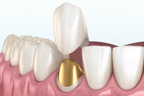 外傷歯の治療