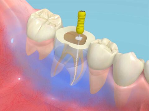 歯周病新分類と歯周組織再生療法の講演