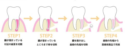 歯根端切除術
